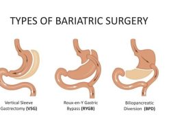 Bariatrik: Satu Penyelesaian Untuk Obesiti