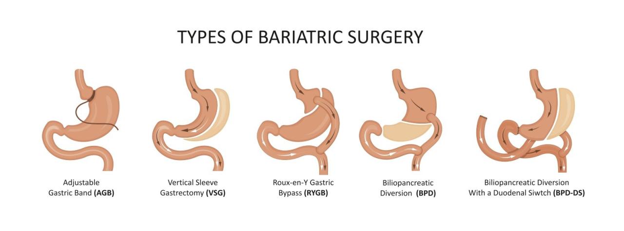 Bariatric